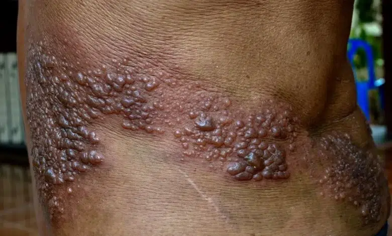 Shingles: Recognizing the Symptoms