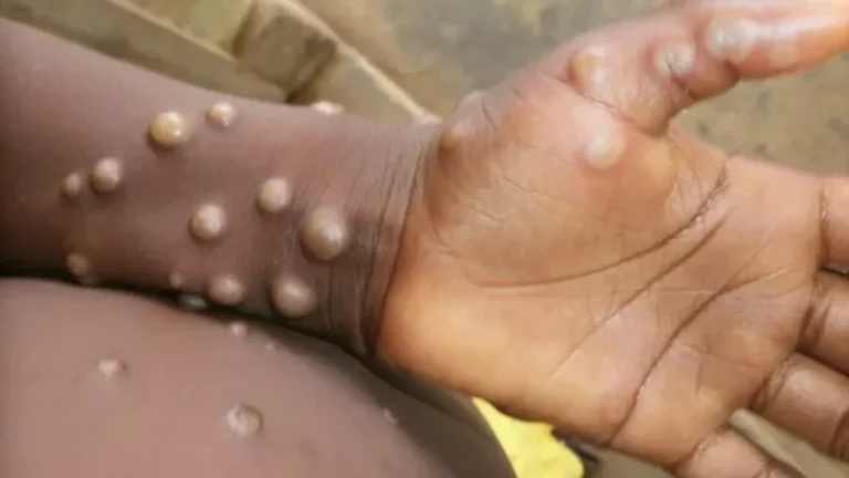 Rising Mpox Infections in South Africa Prompt Health Department Warning