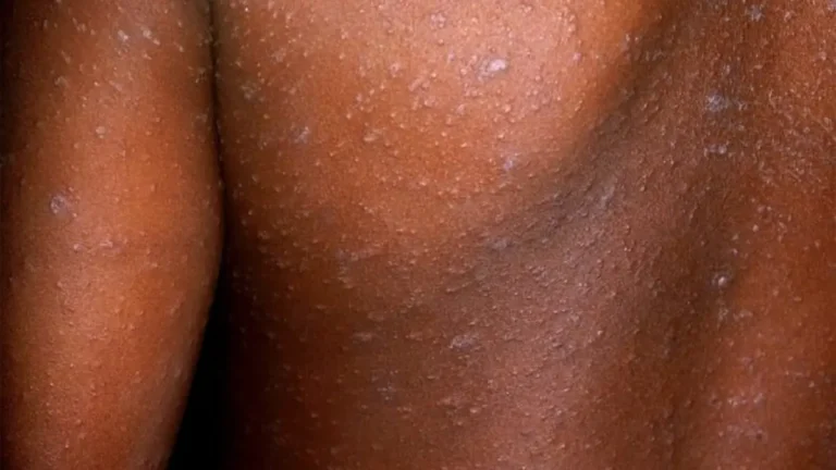 How Schools and Crèches Are Helping Fight Measles Outbreaks in Gauteng