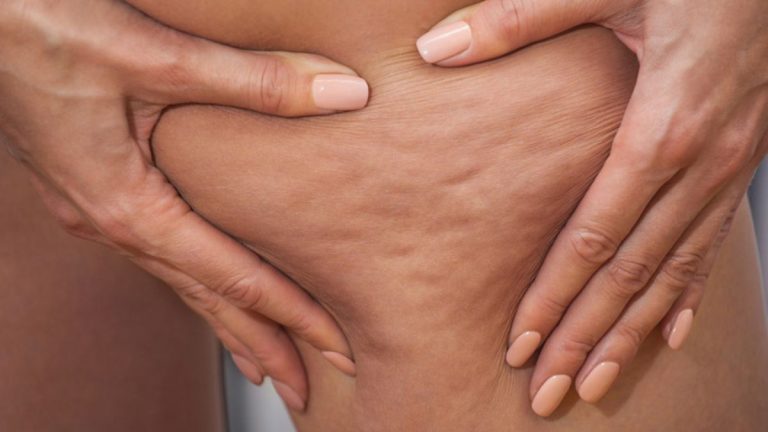 How to Reduce Cellulite According to Experts
